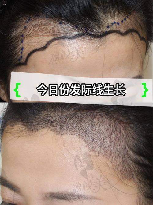 发际线种植后能达到怎样的成效？