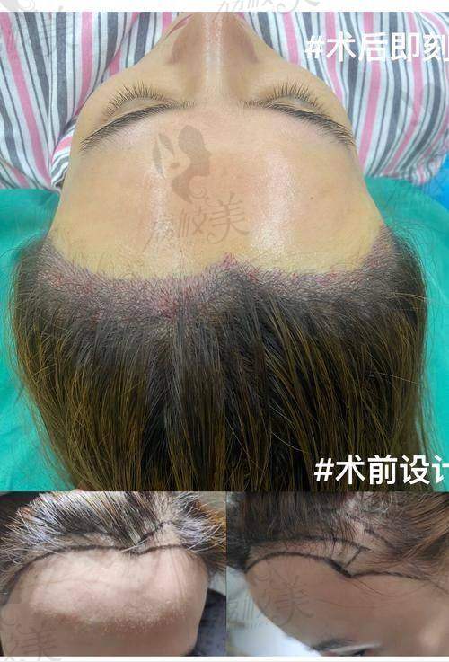 天津熙朵朱秀红医生操刀，发际线种植仅9800元起，开启你的焕颜之旅！ 
