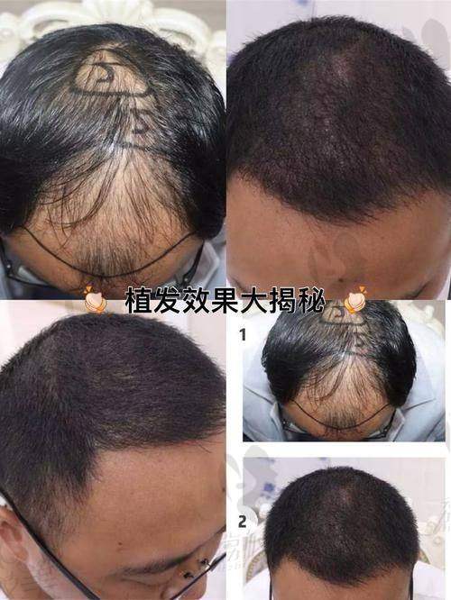 天津熙朵不剃发植发有哪些独特之处？