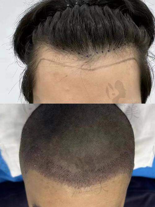 不剃发植发价格是如何分阶的？