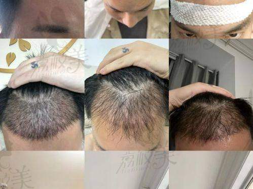 如何选择适合自己的不剃发植发方案？