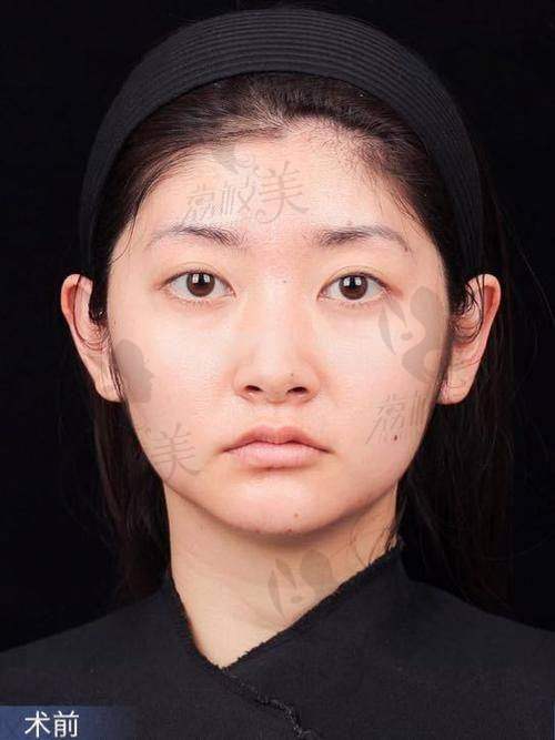 北京润美玉之光医疗美容孫勁勁：真人实例见证奇迹