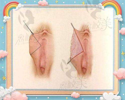 李养群医生口碑怎么样？走进成都八大处医院，看私密整形患者真实评价！