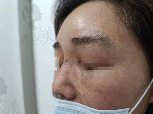 北京润美玉之光医疗美容孙劲劲胶原馒化修复4600元起，重塑美丽效果惊艳！ 