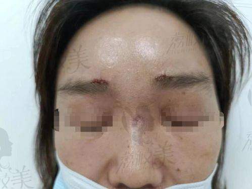 北京润美玉之光孙劲劲胶原馒化修复：口碑爆棚啦！