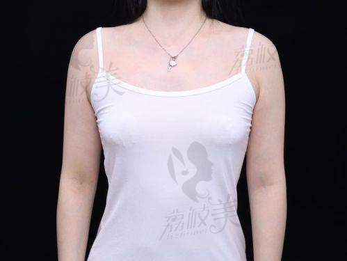 铂蕴假体隆胸的术后护理需要注意什么?
