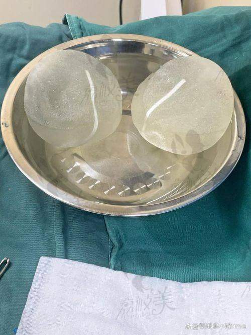武汉五洲医院在铂蕴假体隆胸方面的配套服务如何?