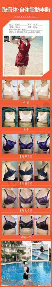 铂蕴假体隆胸有哪些成效和优势?