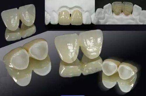 儿童适合的牙套有哪些？