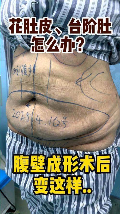 谢宏彬腹壁成形手术口碑好收费62800元，重塑平坦小腹自信穿露脐装，辣妈必备