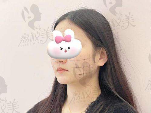 深圳联合丽格王洪军擅长做面部少女抢收费19800元起,甜美少女感拉满,C位出道颜值爆表