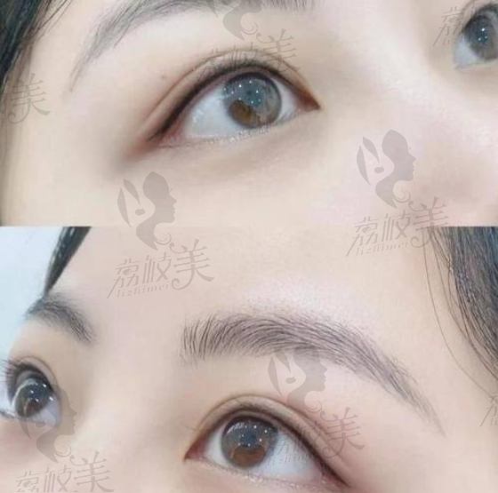 济南激光脱毛哪家医院做的好？智能温控技术是关键