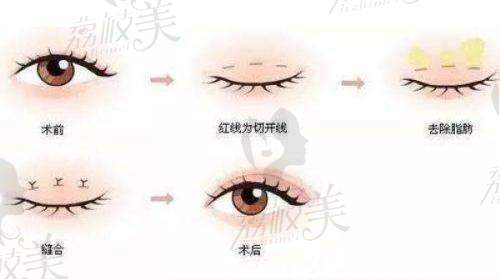 肖文明医生做双眼皮修复吗？重庆当代整形眼部修复大咖，技术口碑大起底！