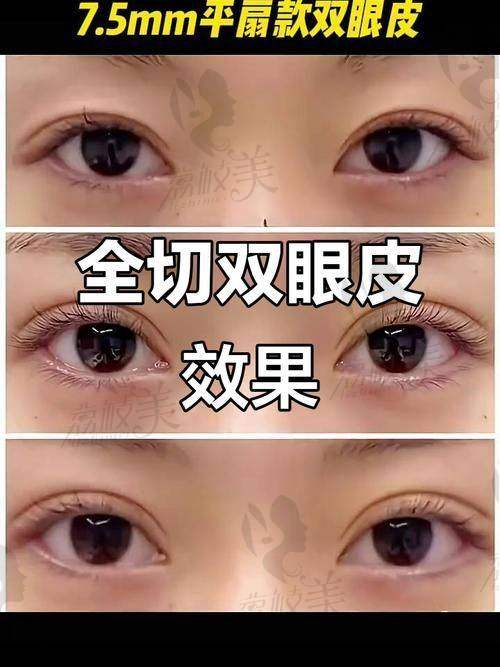 做双眼皮修复会特别痛特别麻烦吗？实际体验告诉你不会！