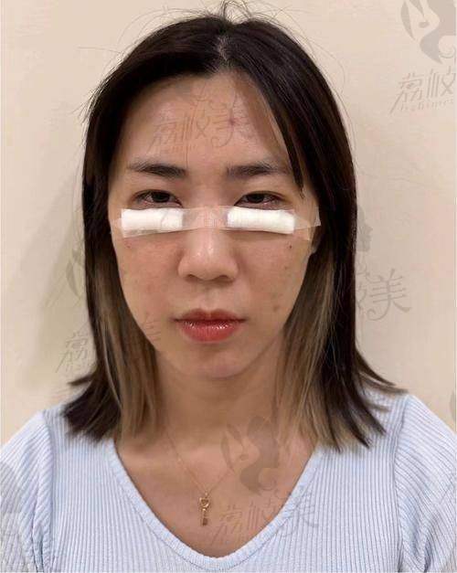 北京轻美颜医疗美容诊所王子彦4C不开刀去眼袋26800元起，无痕减龄效果惊艳！ 