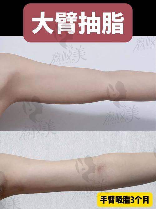中山贝熙医疗美容未来展望：美臂之旅永不止步