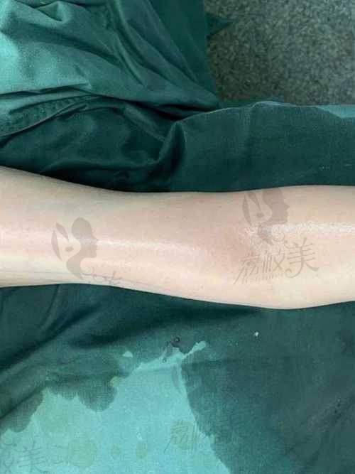 中山贝熙医疗美容：手臂环吸的优势大揭秘