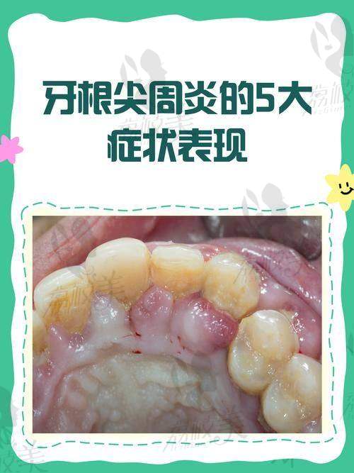 成都医大口腔医院根管治疗费用不贵，1290元起轻松解决“牙”气烦恼