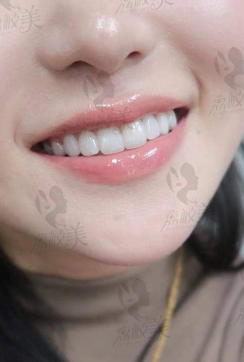 活动时间不等人,贴面项目优惠常有隐藏款