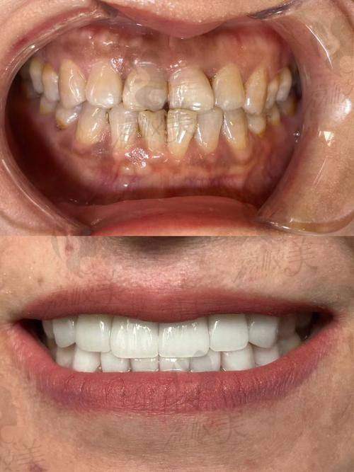 什么是牙齿贴面?一文解锁搜索热词