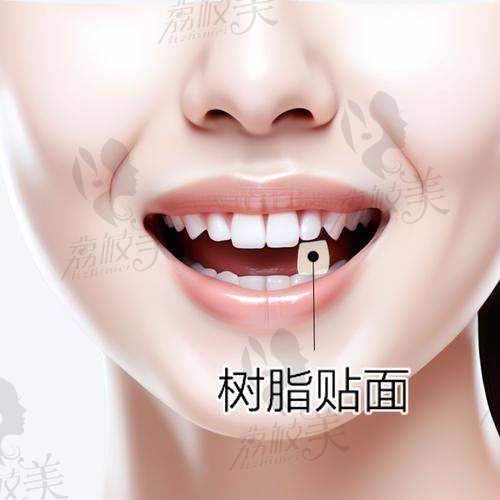 贴面与矫正的区别,有必要同时做吗?