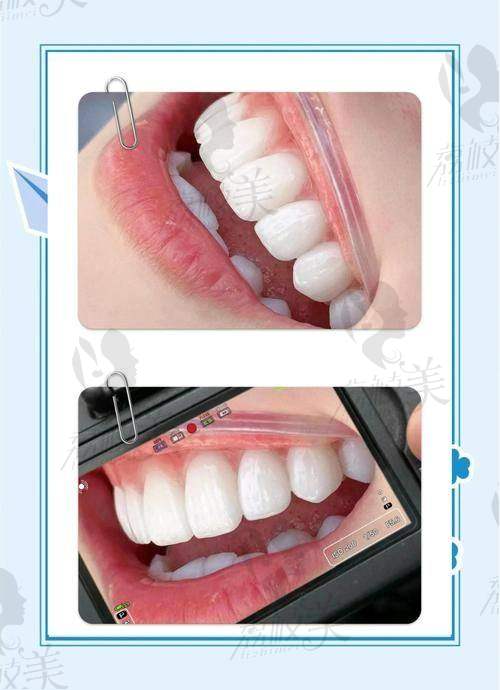 佛山曙光金子口腔牙齿贴面价格1280起，高颜值速成秘籍上线，美笑计划轻松解锁