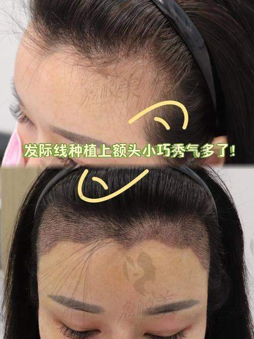 北京碧莲盛开启发际线种植特惠，16000元起重塑自然浓密发际线！ 