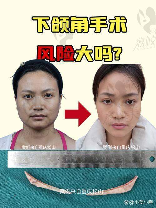 北京圣嘉荣医院获四级手术资质，黄大勇院长磨骨技术惊艳业界！