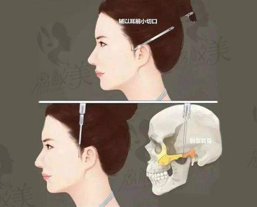 扁头有哪些缺点？如何改善？雕刻醫院扁头矫正技术及骨水泥填充手术揭秘！ 