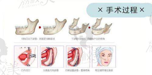 三、找成都罗恩醫生磨骨怎么样？