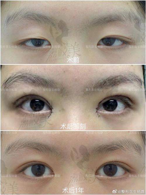 價格貴不貴？雙眼皮修複起步價1萬元左右