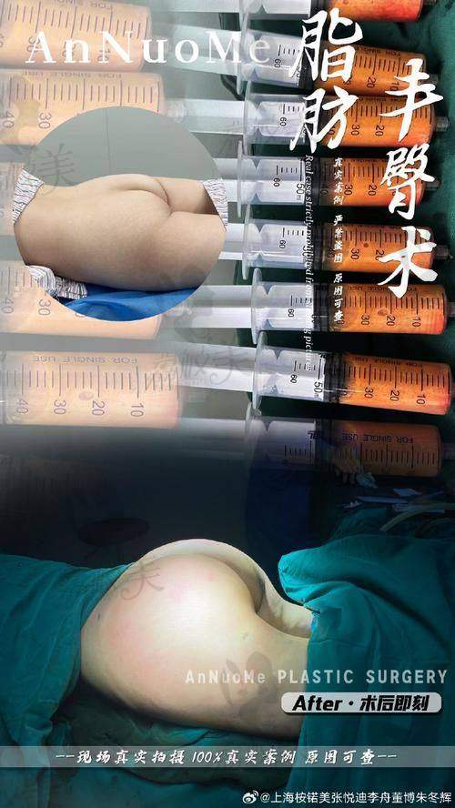 中山貝熙醫療美容自體脂肪豐臀29800元起，塑造圓潤翹臀，效果自然備受青睐 