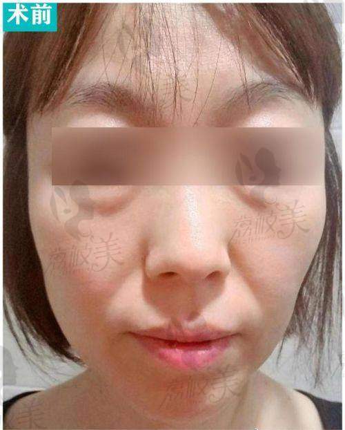 王易彬面部提升怎麽樣靠譜嗎？從技術到實操全方面解析！