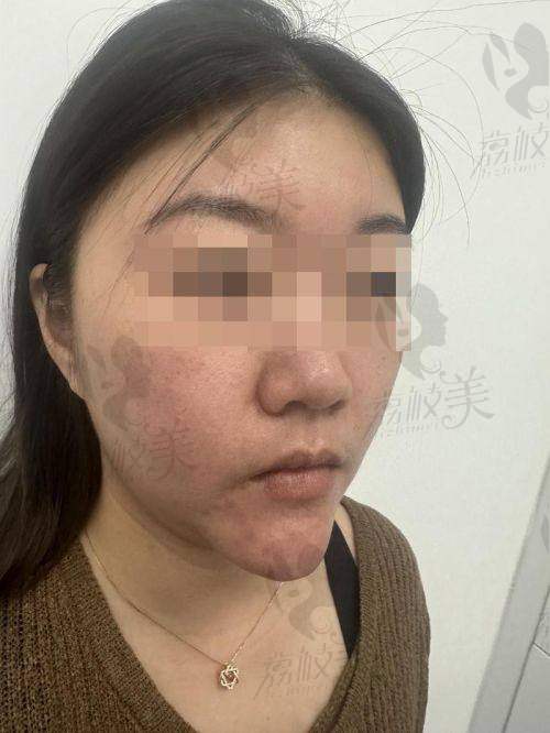 哪些人群适合黎星醫生的取出生长因子手术？