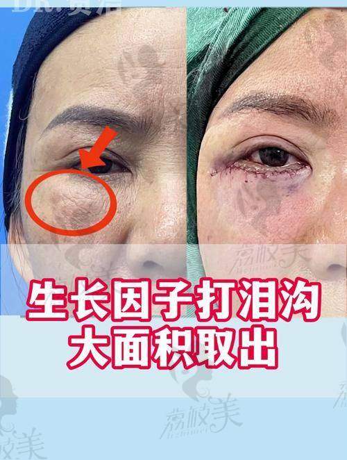 黎星醫生取生长因子技术有什么亮点？操作精密才是核心