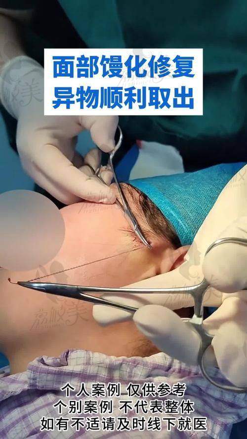 成都张立涛醫生馒化脸修复减容技术好，让你的脸告别 “馒态”，重回紧致！