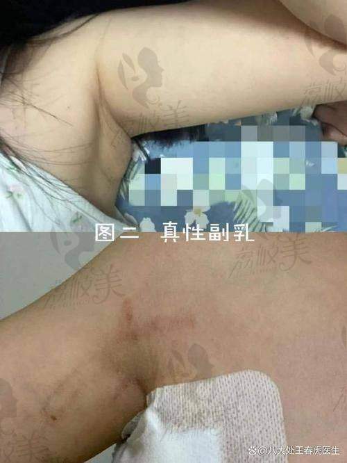 中山貝熙醫療美容副乳吸脂13800元起，高效減脂重塑胸部線條，效果驚豔！ 