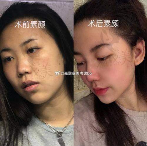 中山贝熙医疗美容:9800元开启小脸魔法之旅