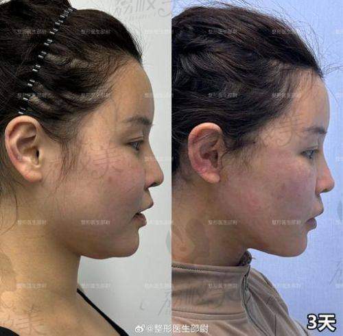 中山贝熙医疗美容真人实例:见证小脸奇迹