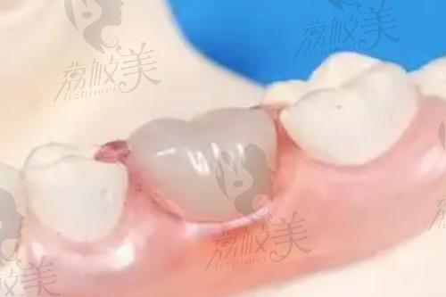 美国3mp60树脂补牙580贵吗?看价格表就一清二楚了