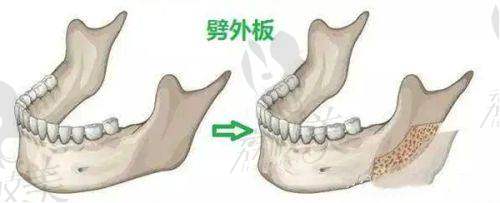 北京颈部拉皮哪家医院较好？——拉皮手术价格情况