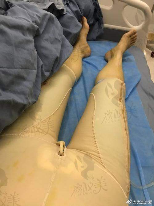 中山贝熙大腿环吸：优势特色大揭秘