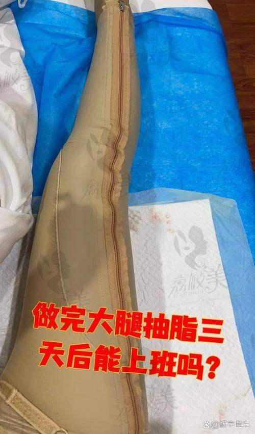 中山贝熙大腿环吸：真人实例太惊艳