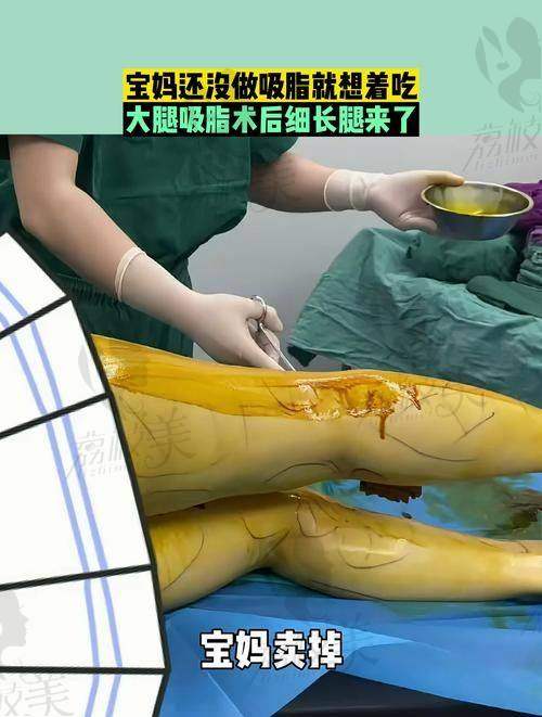 中山贝熙医生团队：大腿环吸的“魔法天团”