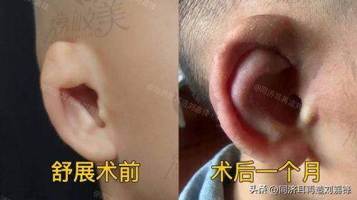 上海海华耳再造价格表曝光，剖析各技术费用差异及报销政策！