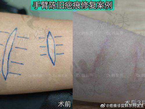 重庆东上医疗美容祛疤痕怎么样？从技术设备到医生团队，全方位解析祛疤实力