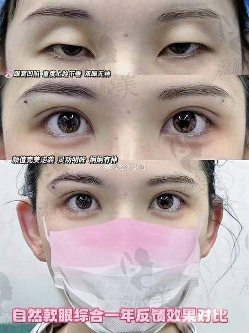 张余光医生技术特点：