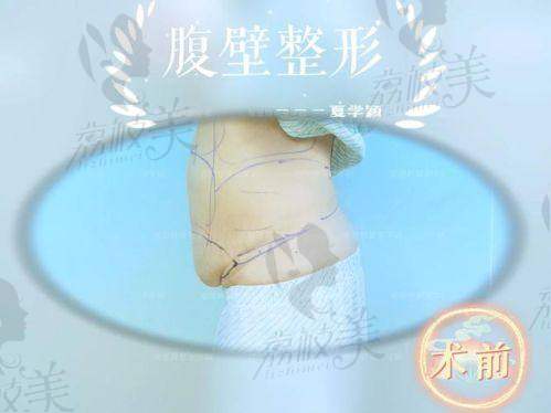成都腹壁成形术做得好的医生排名榜揭晓，哪位医生能帮你实现腹壁逆袭？