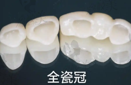 上海拜博口腔江亲远种植牙实例