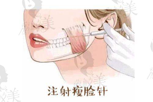 北京漾格医美邢志花操刀瘦脸针，仅2880元起，开启精致小脸新体验！ 